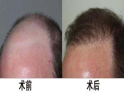 种头发的手术过程 头发种植术的六大步骤